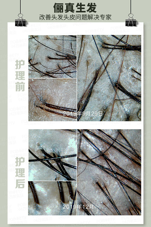 頭油、頭癢