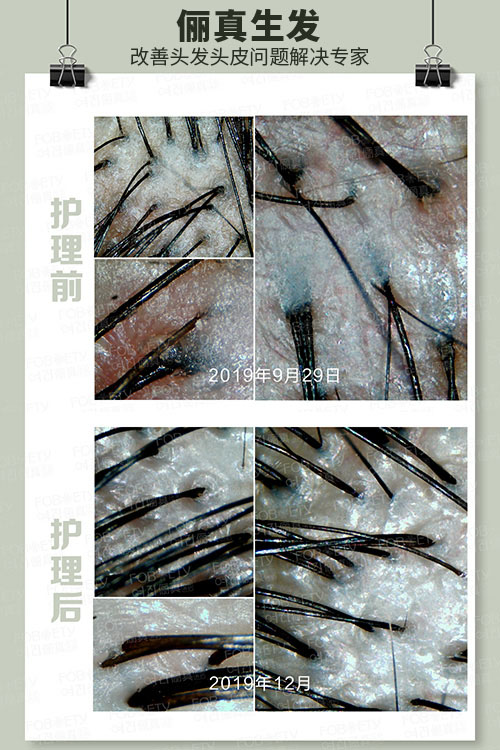 頭油、頭癢