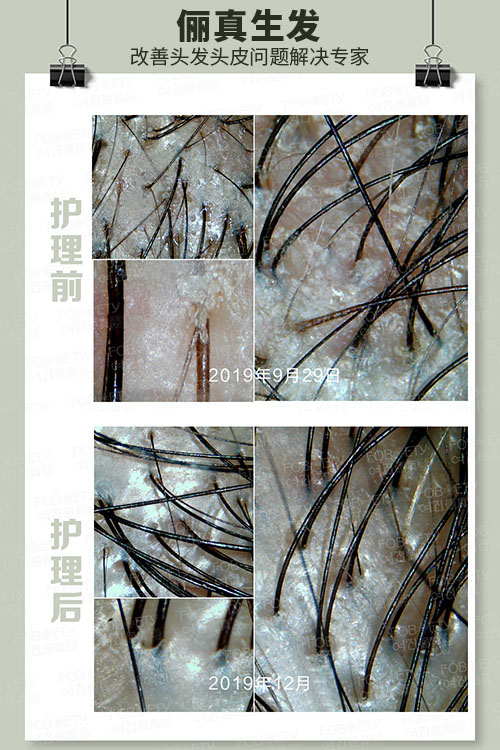 頭油、頭癢